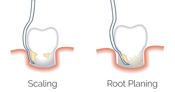 Regular Scaling Vs Deep Scaling or Root Planing