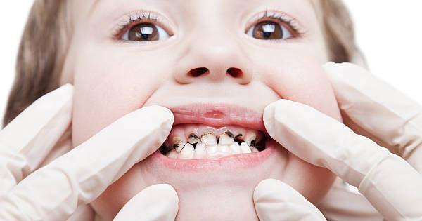 What are the stages of tooth decay (tooth erosion)?