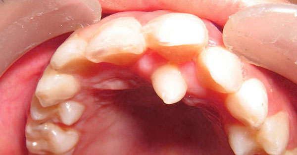 Hyperdontia (Extra Teeth)