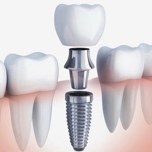 dental implants