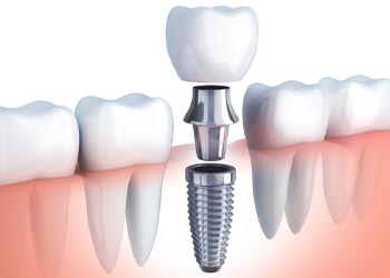 dental implants