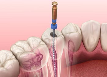 endodontics