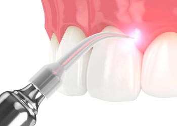 laser dentistry in Vijayawada