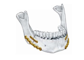 oral maxillofacial surgery