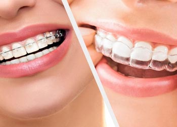 orthodontics in Vijayawada